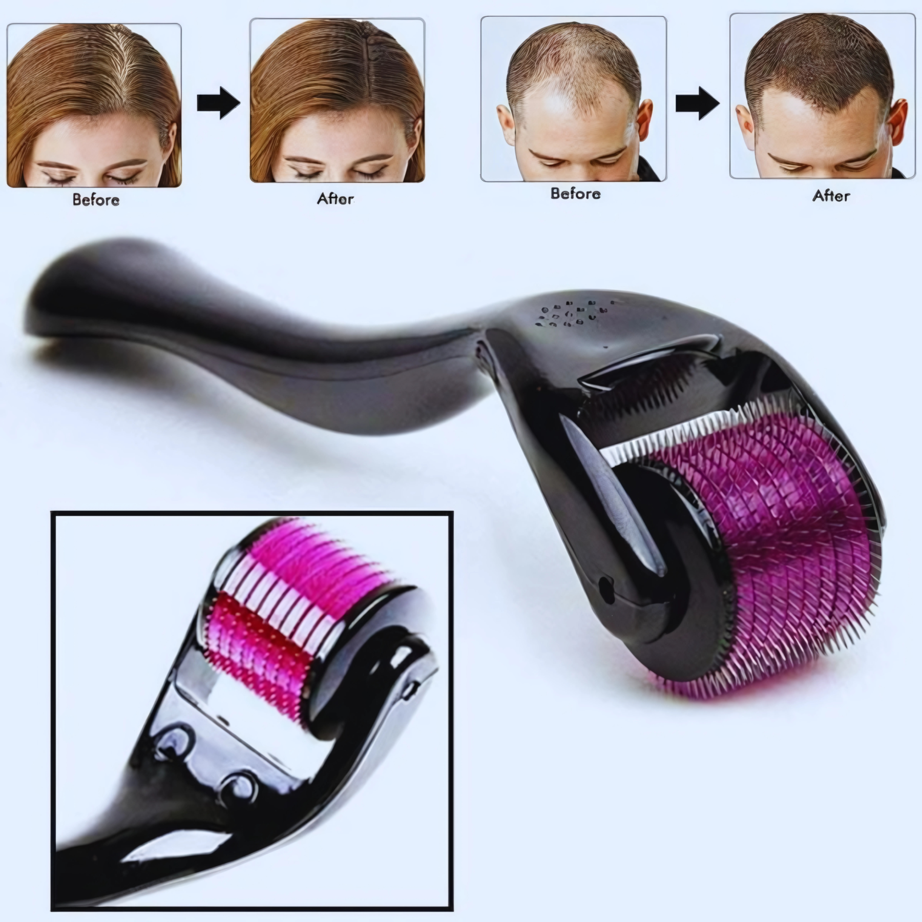 DRS 540 Titanium Derma Roller Hair Growth Beard Microneedle Roller Skin Care Tool Anti Hair Loss For Women and Man Household